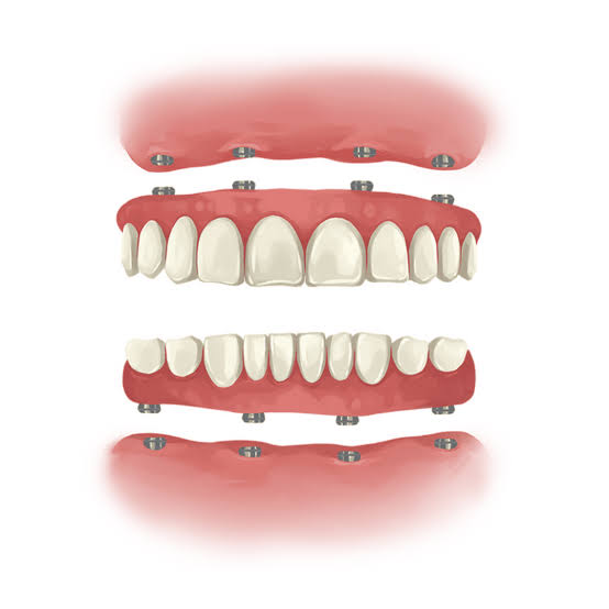 FULL MOUTH REHABILITATION